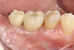 下関市のおおむら歯科医院にて、右下の奥歯にインプラントの治療を行った後の画像